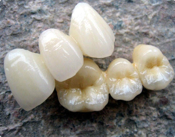 假牙的种类及价格详细介绍图片,目前国内最好的假牙是多少钱