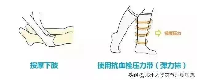 孕期如何预防深静脉血栓,妊娠期静脉血栓的高风险因素