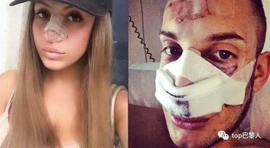 法国情侣豪掷200万,经历15次手术,只为成芭比与肯尼