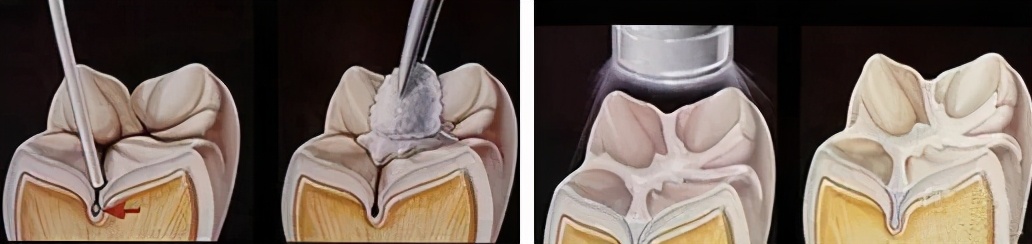 儿童窝沟封闭家长知情同意书,涂氟和窝沟封闭价钱