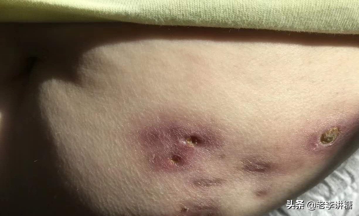 无针头胰岛素注射器哪个耗材实惠,无针注射胰岛素糖友的福音