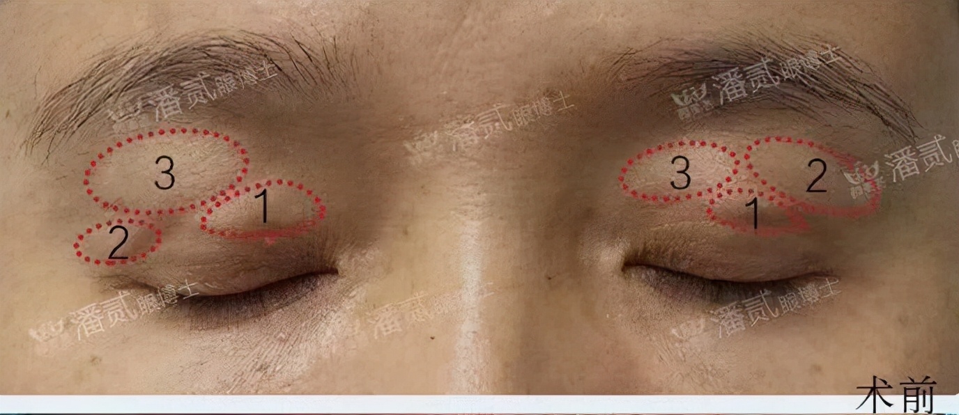 眼皮填充的脂肪凹凸不平怎么办,上眼皮凹陷填充脂肪有危险吗