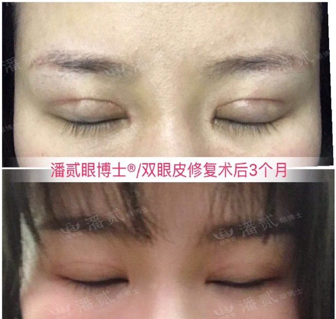 上海马大哈姑娘，稀里糊涂整了容，术后就一个字：丑