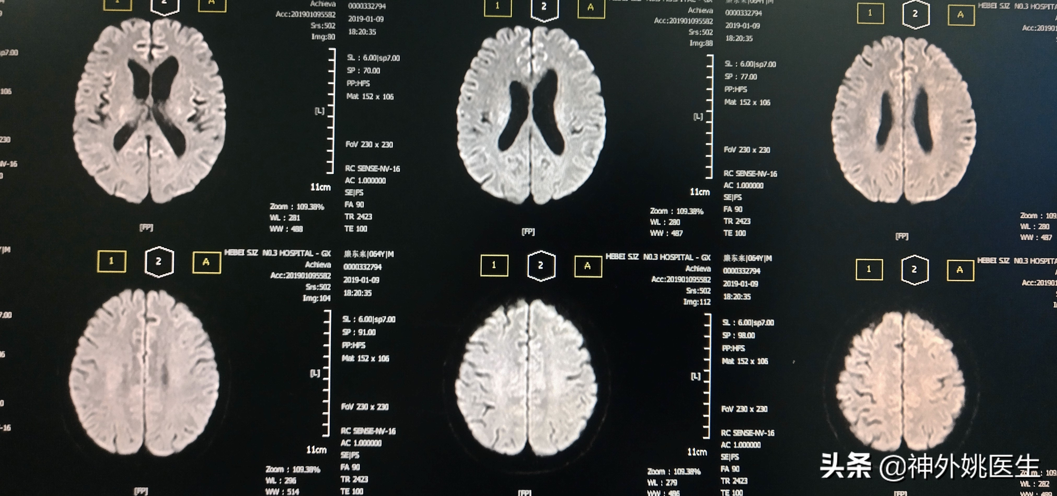 颈动脉狭窄的外科治疗