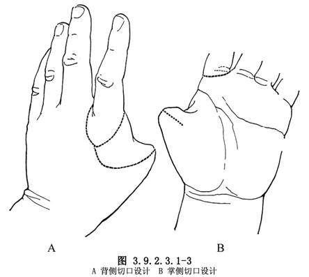 拇指再造术多少钱,拇指再造术哪里最强