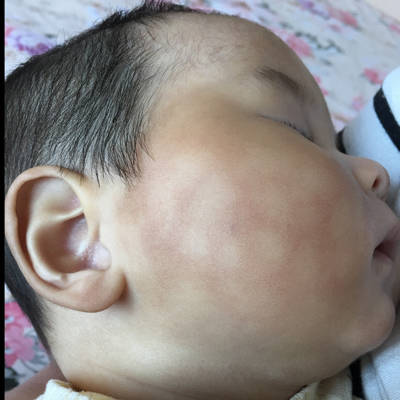 孩子脸上有斑是肚子有虫吗,宝宝脸上长白斑是肚子有虫子吗