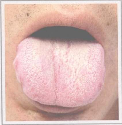 从舌头看身体状况拍照,如何看舌头判断孩子身体状况