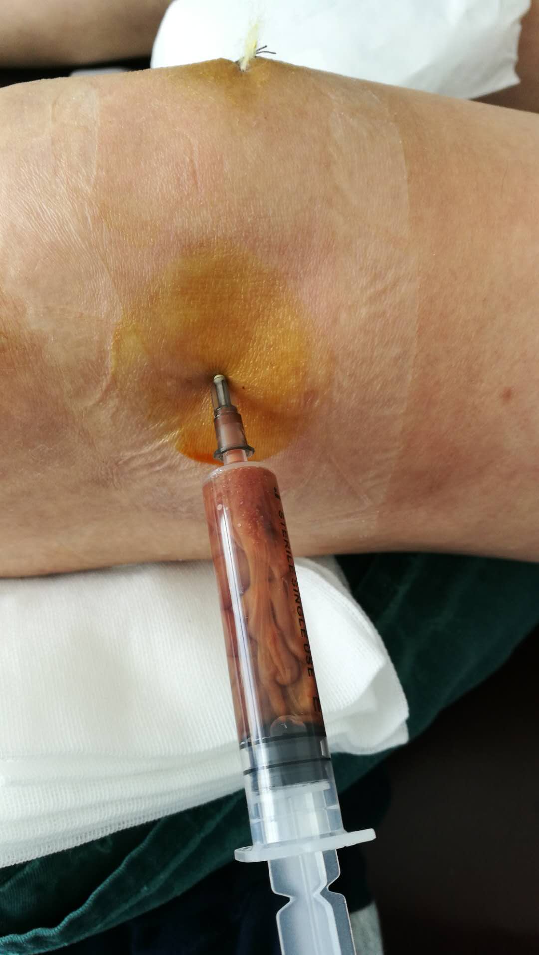 膝盖积水用烤灯能烤好吗？粗盐呢？医生：明确诊断针对治疗是关键