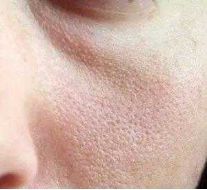 打败毛孔!下一个反孔精英就是你!