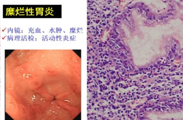 胃黏膜有炎症的表现,胃黏膜炎症的症状是什么引起的