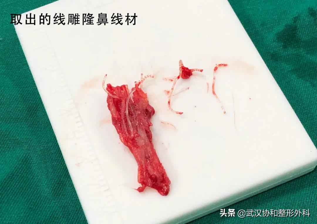 为什么不建议做线雕隆鼻手术,为什么不建议做线雕隆鼻