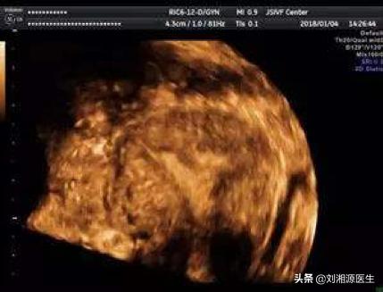 宫腔粘连合并妊娠,宫腔粘连容易导致生化妊娠吗