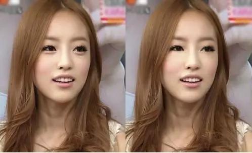 眼袋真实分享,介绍眼袋治疗视频