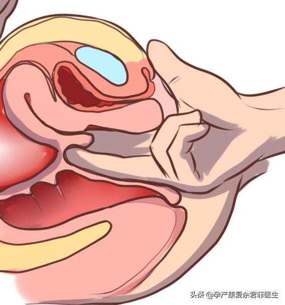 4个好习惯远离盆底问题,怎么预防盆底下垂