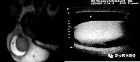 睾丸内部病变,睾丸病变mri