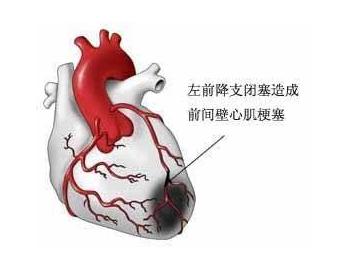 心肌缺血心绞痛用什么药好用,抗心肌缺血的药有哪些