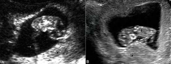 妇科超声和早孕超声有什么区别,明明白白做b超
