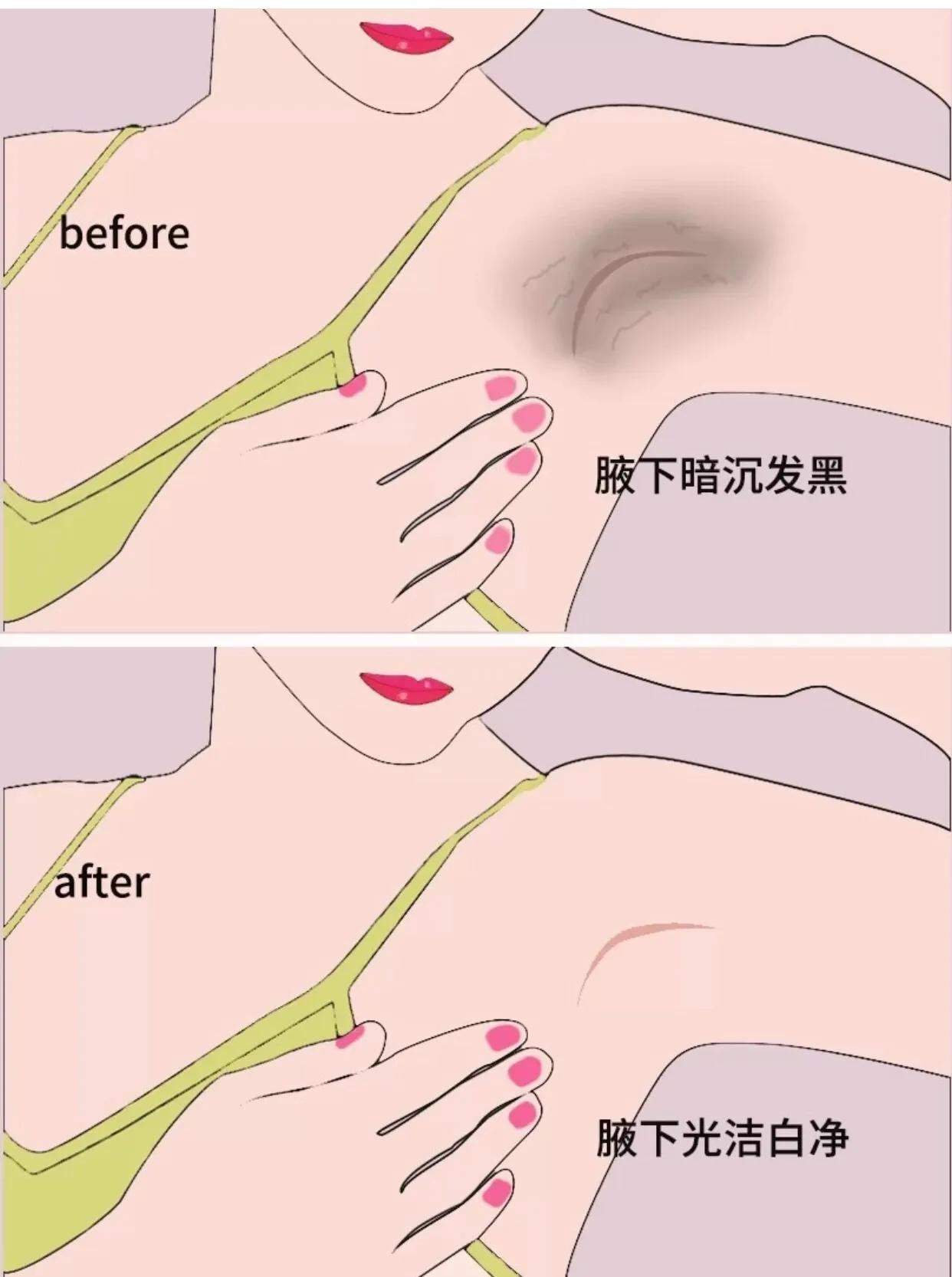 腋下黑怎么穿吊带,夏天穿吊带腋窝黑怎么办