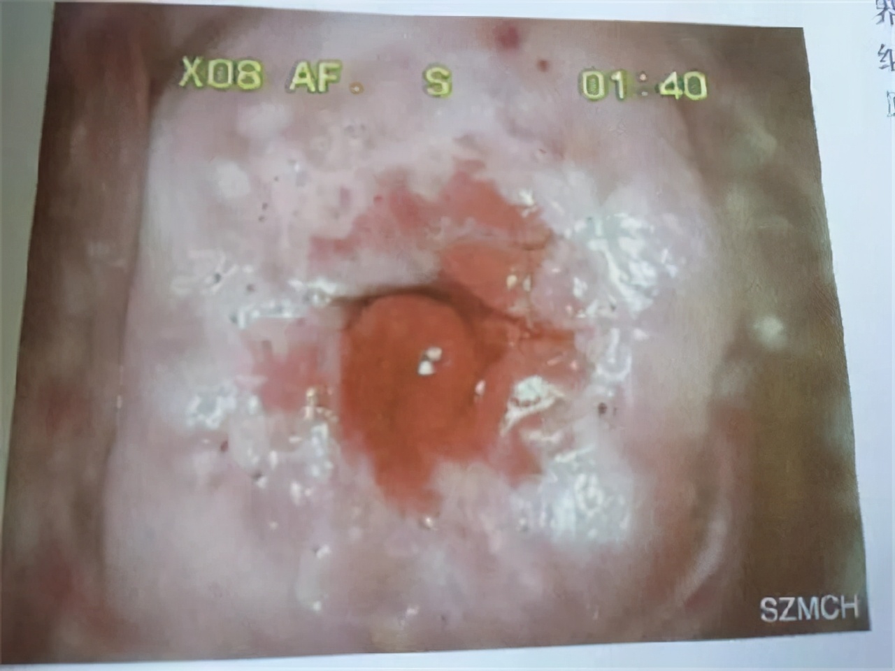 27岁女博士一个月26次患宫颈癌,26女博士一月26次最终查出宫颈癌