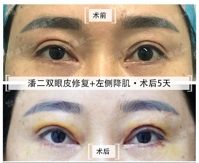 东莞做无痕双眼皮,东莞双眼皮修复