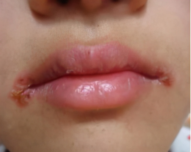 嘴角开裂流黄水结痂是什么感染,嘴角干裂有黄色结痂