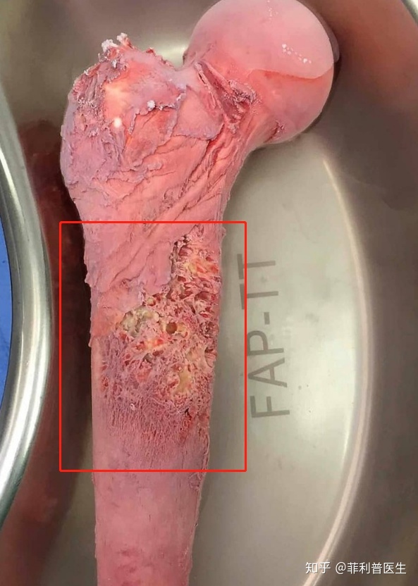 把骨头煮熟抗癌,把骨头煮熟