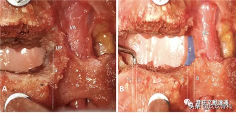 acaf手术适应脊髓型颈椎病吗,acaf术后康复方法