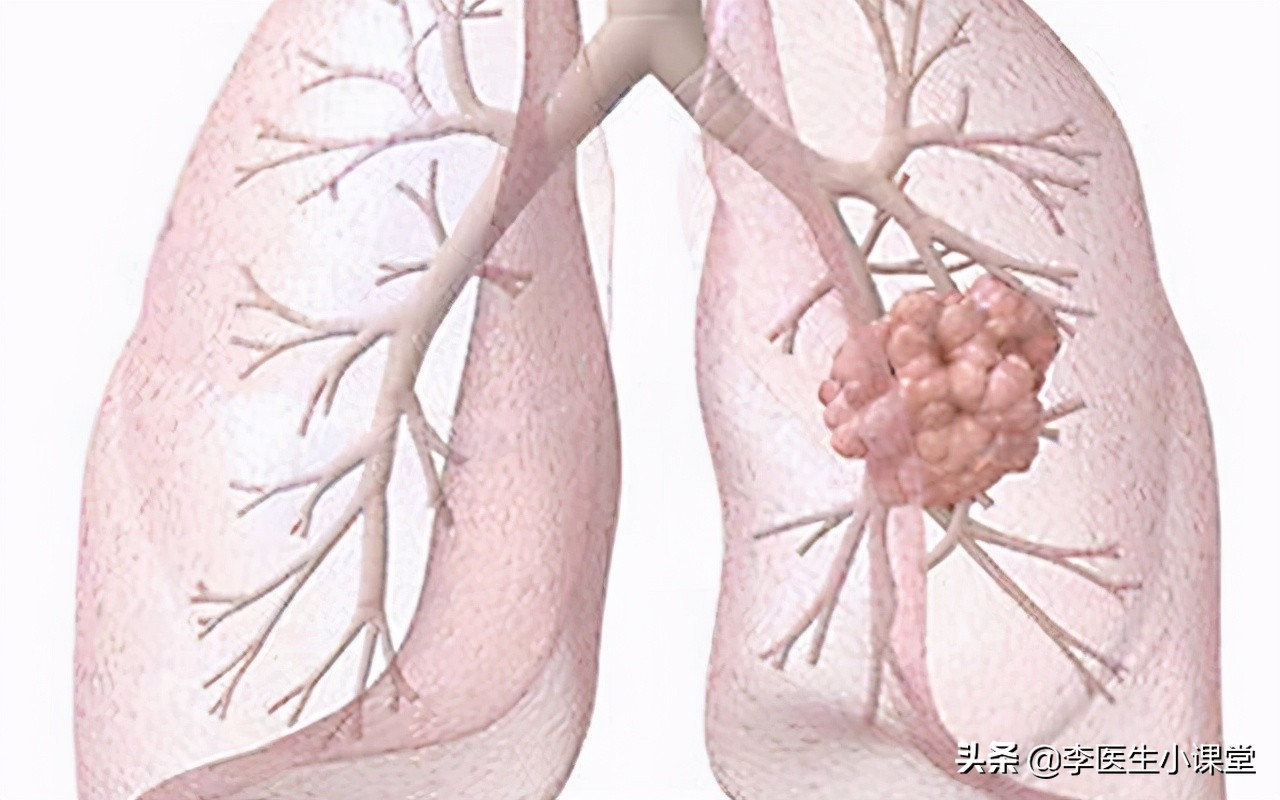 肺癌术后复发或转移，会有征兆吗？再复发还能怎么治？