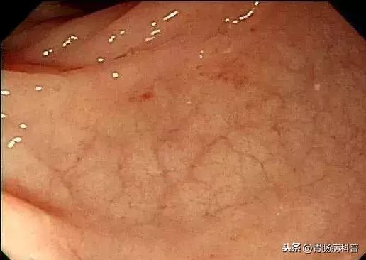 我做普通肠镜的经历及感受,年轻人做普通肠镜可以忍受吗