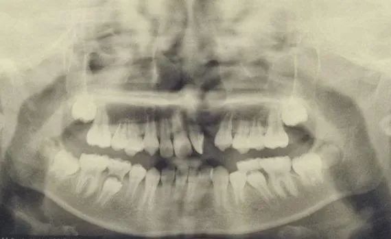 唇腭裂宝宝术后怎么处理,唇腭裂为什么牙齿不整齐