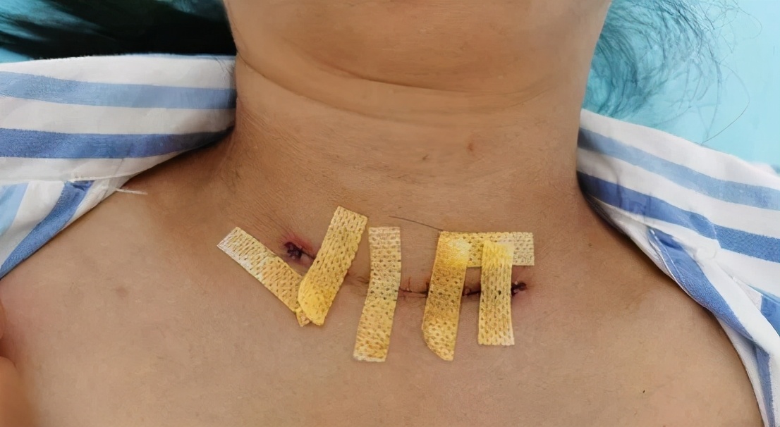 甲状腺结节癌术后会复发吗,甲癌术后甲状腺又长结节