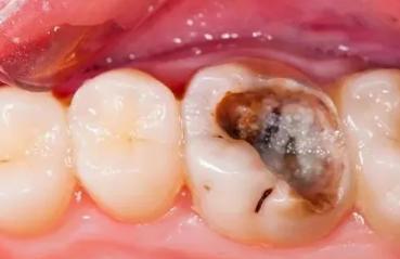 根管治疗为什么要做冠部修复,做完根管治疗以后不补会怎么样