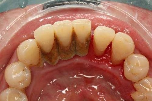 30秒带你了解洗牙,洗牙的过程短视频