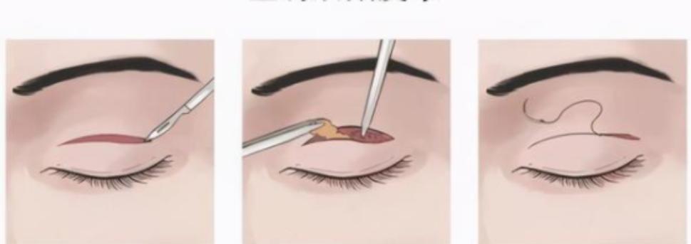 你应该选择哪种双眼皮手术方法,双眼皮手术淡化疤痕的6个小妙招