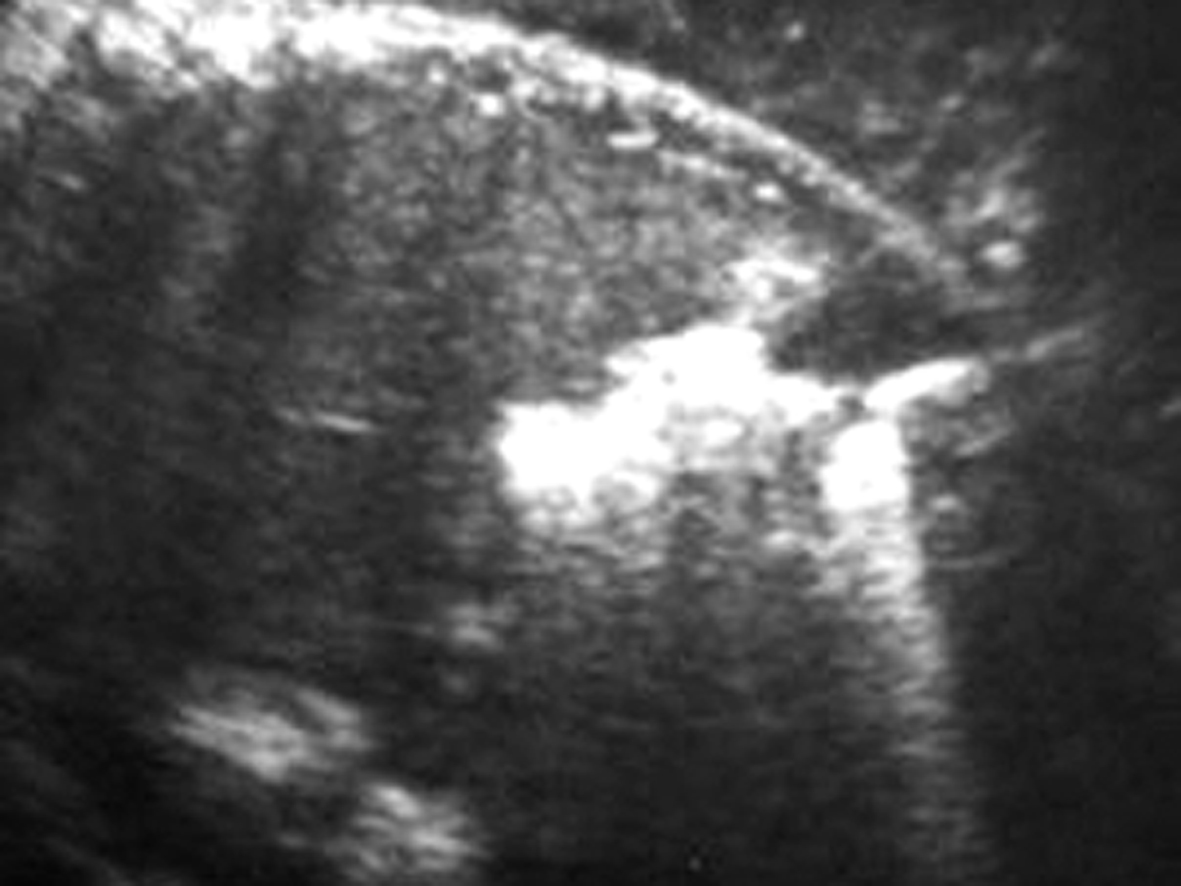 明明白白做超声28-7胎儿消化系畸形：肠道回声增强及肠管扩张