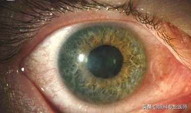 流行性角结膜炎潜伏期,流行性角结膜炎分泌物