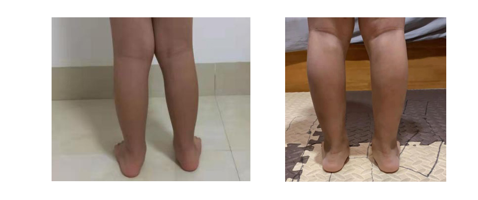 偏瘫足内翻足外翻,足内翻足外翻崴脚