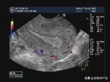 子宫内膜厚薄不均匀,子宫内膜薄该怎么办呢需要治疗吗