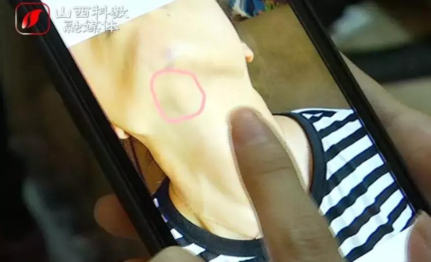 打玻尿酸下巴淤青发紫会栓塞吗,石家庄一女子注射玻尿酸