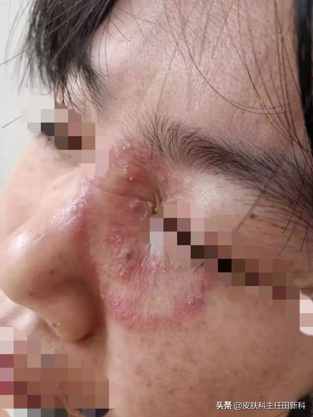 脸上痘印变成癣了怎么回事,痘印长癣