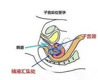 医生,我子宫后位会不会影响怀孕?
