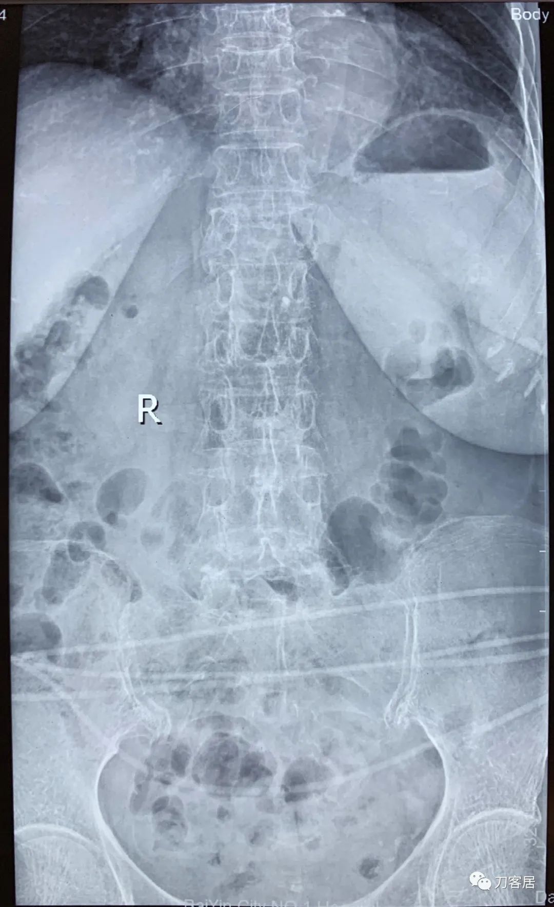 脊柱骨质疏松性压缩性骨折,老年骨质疏松压缩性骨折诊治
