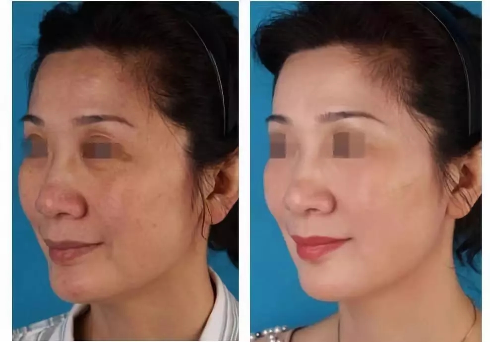 40-50岁女性医美抗衰项目,医美抗衰老哪个方法好