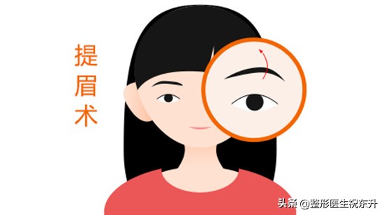 内窥镜提眉和手术提眉哪个好,提眉术和切眉手术哪个简单