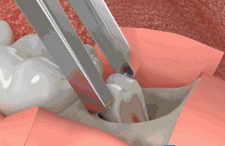 拔牙打麻药是用针扎还是抹上去,拔牙打麻药对脑神经有影响吗