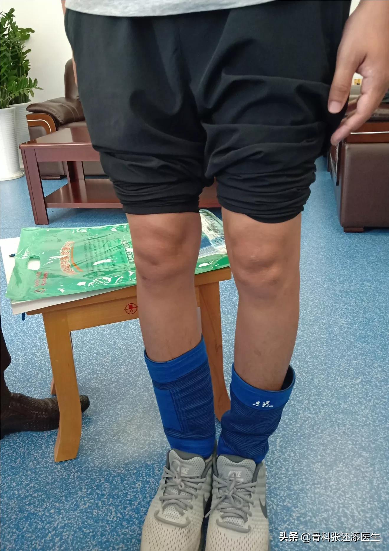 詹姆斯是o型腿能矫正吗,詹姆斯o型腿影响打球吗