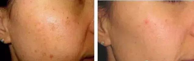 光子嫩肤有关常识,光子嫩肤科普知识