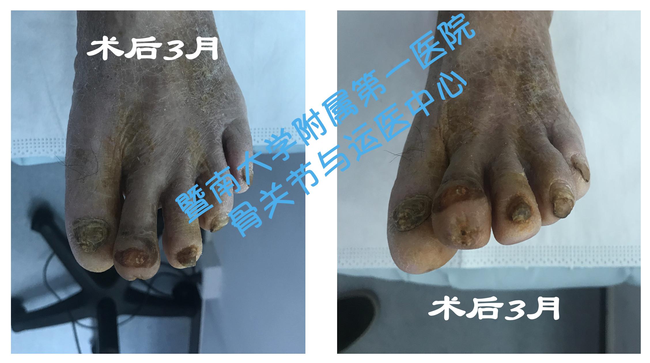 糖尿病足截肢后怎么长肉快,糖尿病足不截肢的最新疗法