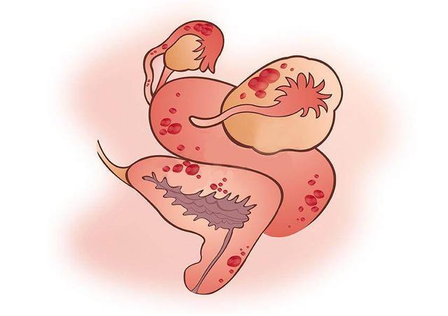 妇科检查宫颈囊肿严重吗,宫颈囊肿的危害有哪些呢