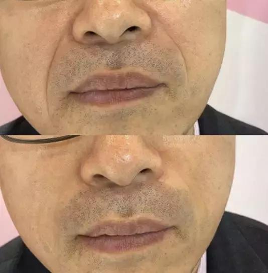 护肤黑科技顶级医美,用黑科技去除眼袋肿了十天